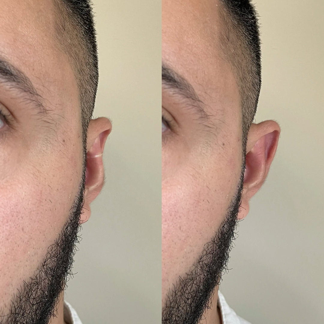 Earo – Correcteur d'Oreille Invisible