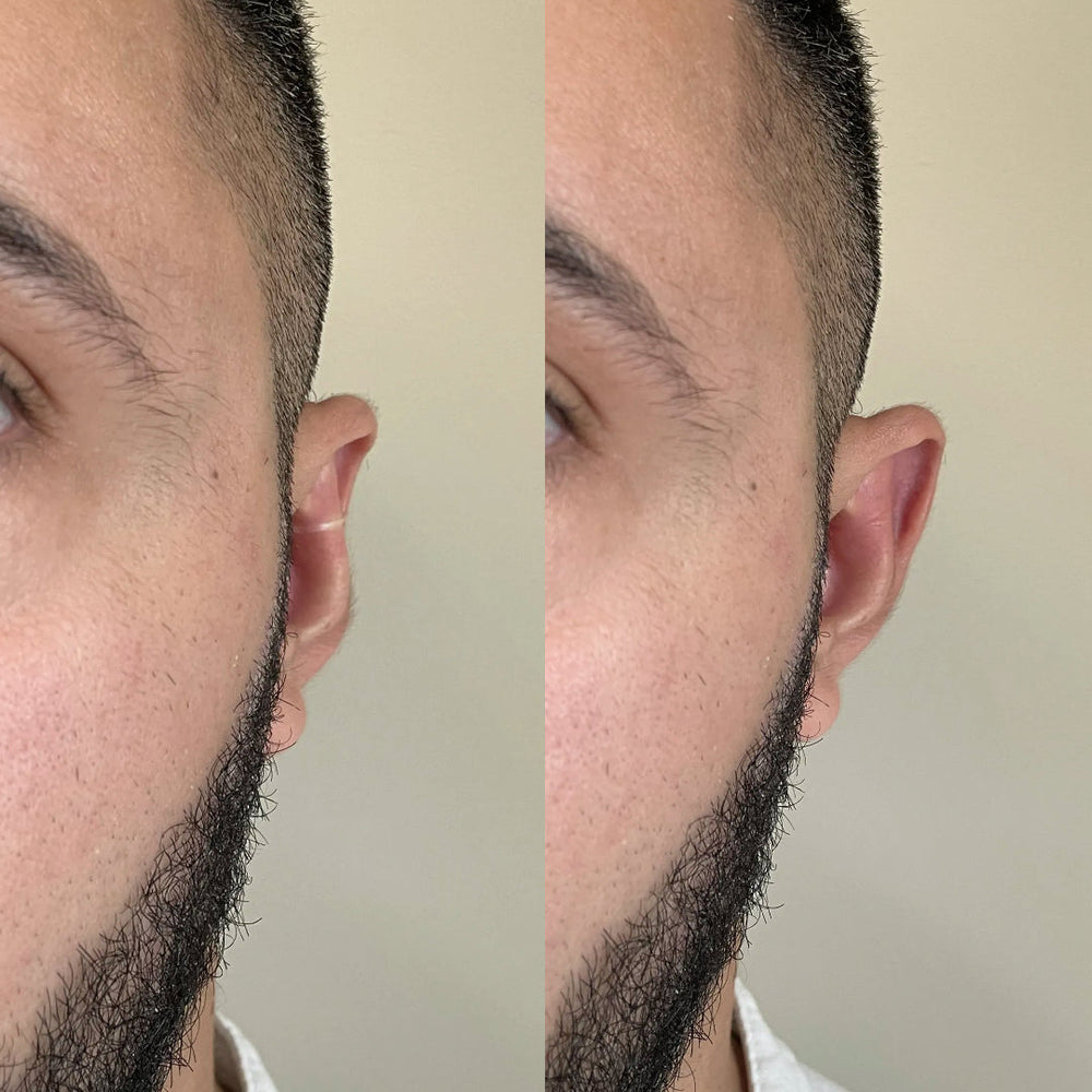 Earo – Correcteur d'Oreille Invisible